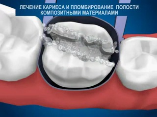 Материалы для пломбирования зубов 2 класс Материалы для пломбирования зубов 2 класс