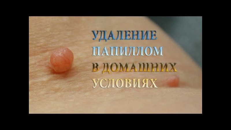 Удаляем бородавки народными средствами в домашних условиях Удаляем бородавки народными средствами в домашних условиях