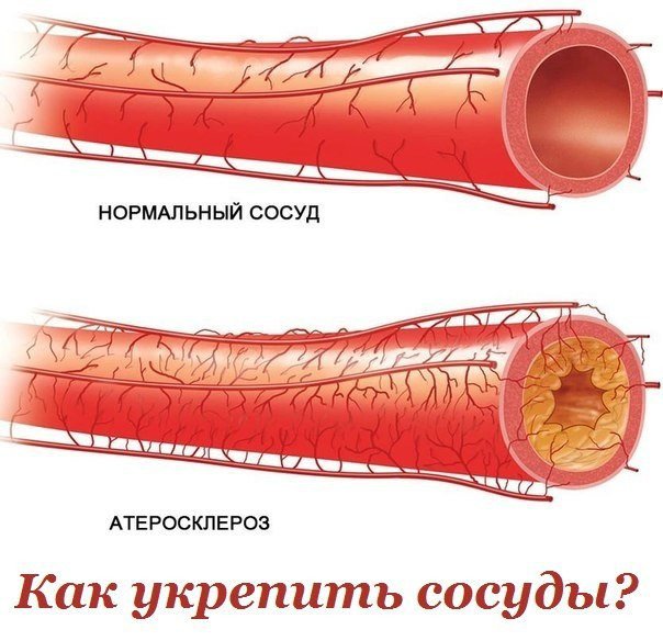 Как укреплять сосуды в домашних условиях Как укреплять сосуды в домашних условиях