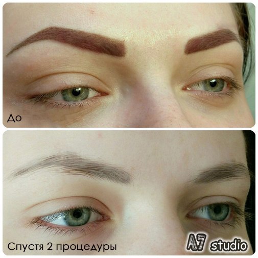 Выведение татуажа в санкт-петербурге Выведение татуажа в санкт-петербурге