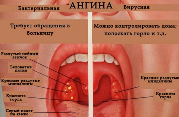 Ангина у ребенка в домашних условиях Ангина у ребенка в домашних условиях