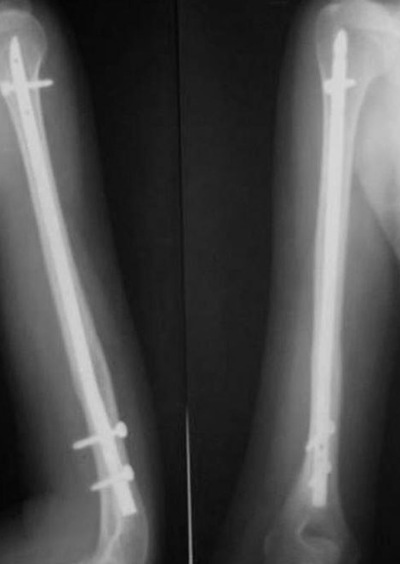 остеосинтез перелома плеча