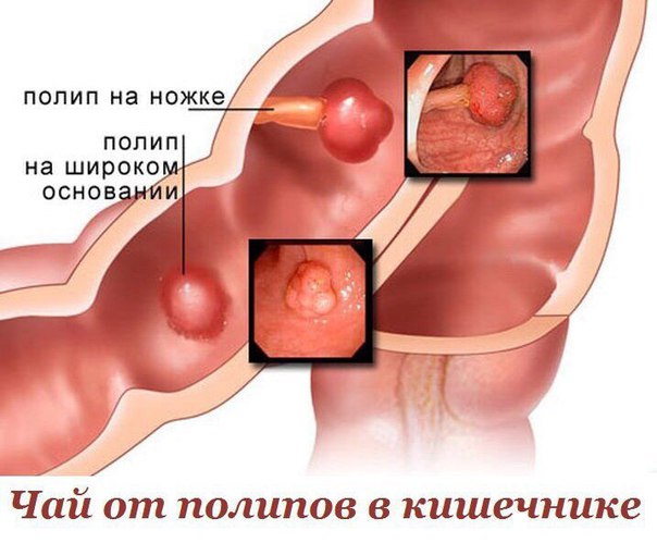ЧАЙ ОТ ПОЛИПОВ В КИШЕЧНИКЕ 