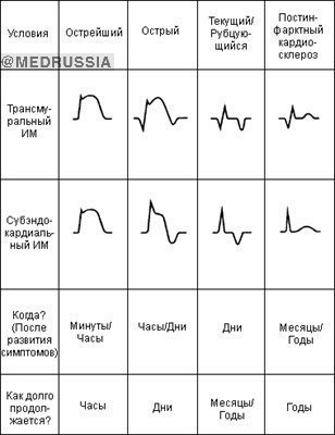 Изменения ЭКГ при инфаркте миокарда (ИМ)