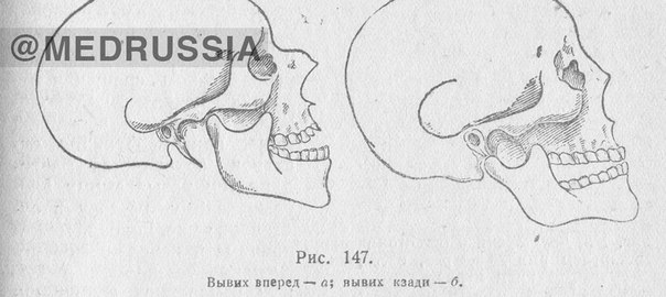 Вывих нижней челюсти 