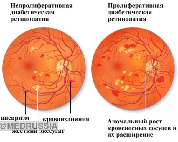 Диабетическая ретинопатия