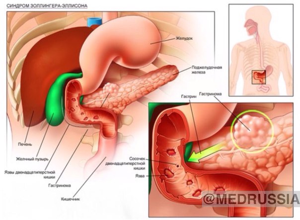Синдром Золлингера-Эллисона