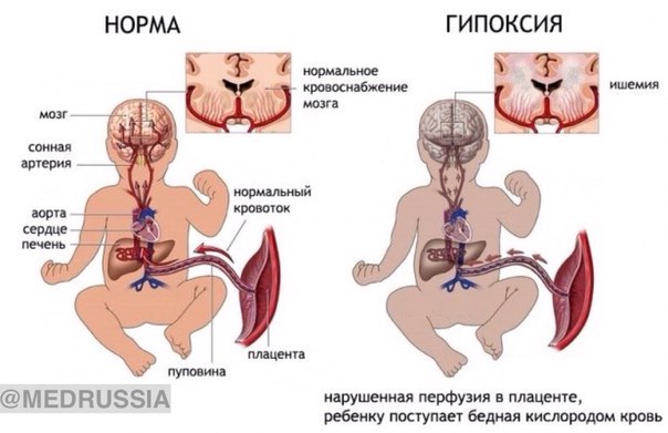 Фетоплацентарная недостаточность 