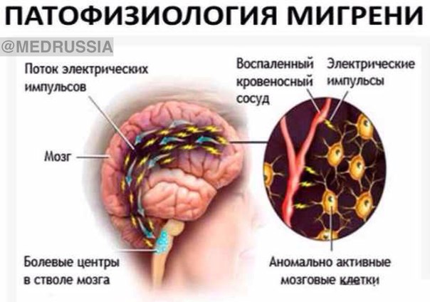 Мигрень — сильная головная боль, которая часто сопровождается нарушением зрения,  тошнотой и рвотой. Первые приступы обычно начинаются в 30 лет, с увеличением возраста растет заболеваемость. Чаще наблюдается у женщин. Иногда может быть семейным заболеванием. Приступы могут быть спровоцированы стрессами и некоторыми пищевыми продуктами. Первые приступы мигрени редко наблюдаются у людей старше 40 лет, но были зафиксированы у детей 3 лет . Мигрень может рецидивировать с различными интервалами. Некоторые люди переживают несколько приступов в месяц, а другие всего один приступ и год. Большинство людей приходит к выводу, что с возрастом приступы становятся реже и легче.