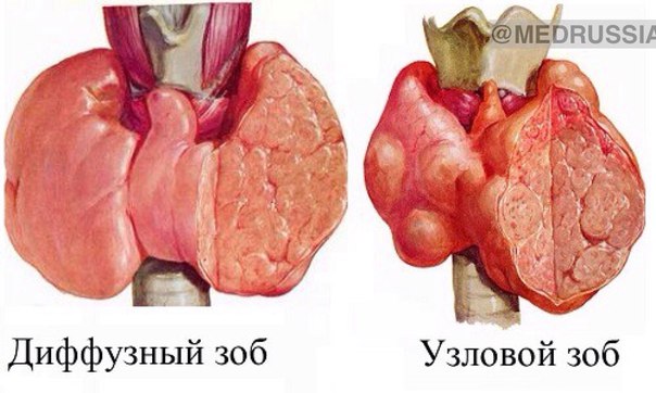 Узловой токсический зоб 