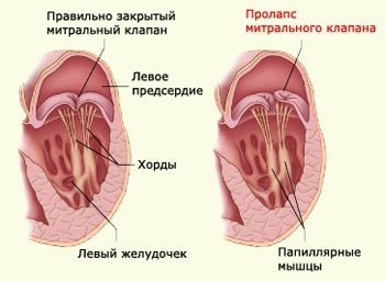 Пролапс митрального клапана