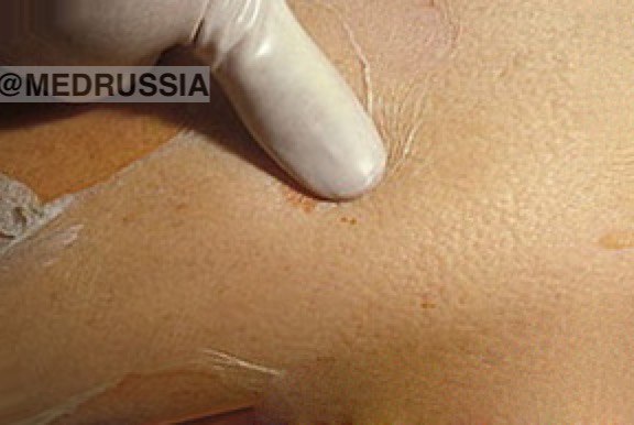 Синдром Лайелла