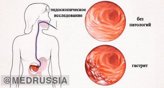 ГАСТРОДУОДЕНИТ 