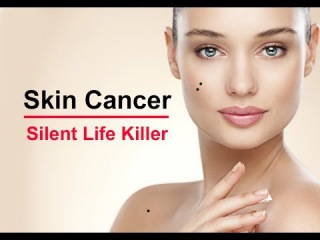 Skin Cancer – A Silent Killer Melanoma Disease
