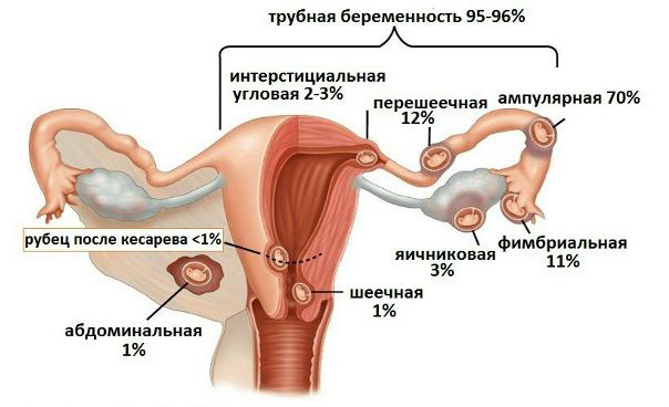 Трубная беременность 