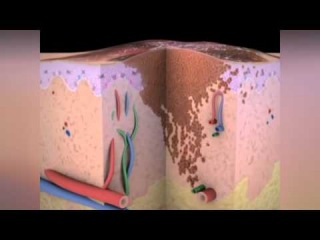 Melanoma the Skin Cancer - How the Cancer Develops