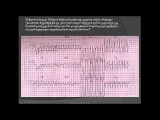 ეკგ. ფართოკომპლექსებიანი ტაქიკარდია. დიფƮ