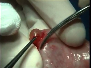 Surgical removal of Mucocele or Mucous Retention Cyst from Lower Lip