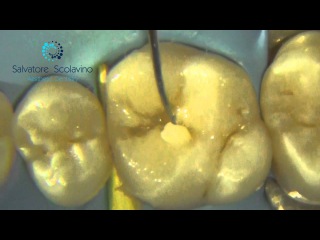 Second Class Restoration... Clinical Steps