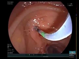 Pancreatoscopic Removal of a Large Impacted Pancreatic Duct Stone