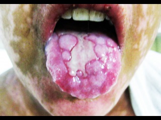 Face Of Stevens Johnson Syndrome! Education, Cysts, Sluffing, Abscesses, Documentary