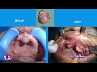 Maxillary cyst - Nasopalatine Duct Cyst