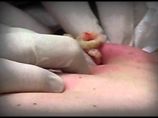 BIGGEST CYST ON THE PLANET | Operation