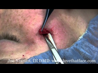 Cosmetic Removal Of Sebaceous Cyst on the Face