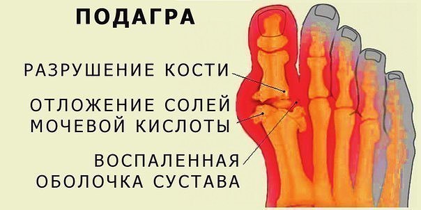 ЕСЛИ ЗАМУЧИЛА ПОДАГРА 