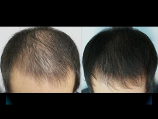 Minoxidil- №1 средство для стимуляции роста бороды и волос на голове