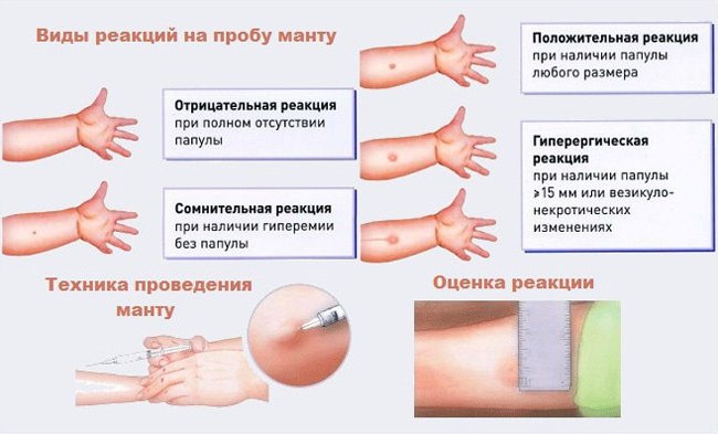 если диаскинтест отрицательный а манту положительная у ребенка что это значит. Смотреть фото если диаскинтест отрицательный а манту положительная у ребенка что это значит. Смотреть картинку если диаскинтест отрицательный а манту положительная у ребенка что это значит. Картинка про если диаскинтест отрицательный а манту положительная у ребенка что это значит. Фото если диаскинтест отрицательный а манту положительная у ребенка что это значит