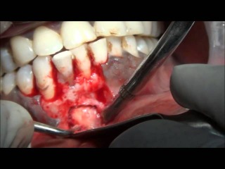 Surgical removal of BIG Periapical cyst in lower mandible VIDEO