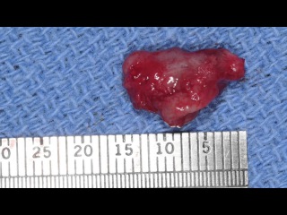 Marsupialization / Decompression of Odontogenic Cysts- Part 2