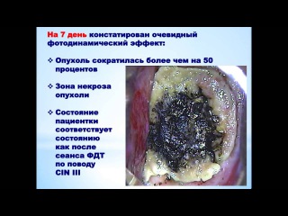 Результаты лечения рака шейки матки 2-3 стадии (cin 2-3)