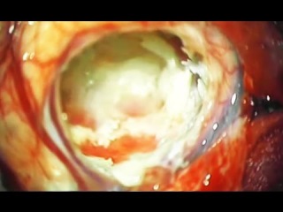 Massive Brain Cyst Removed on Video