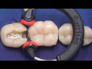 MOD Composite Restoration - Bulk-fill Technique. Стоматология.