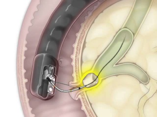 ERCP for Removal of a Stone in the Bile Duct
