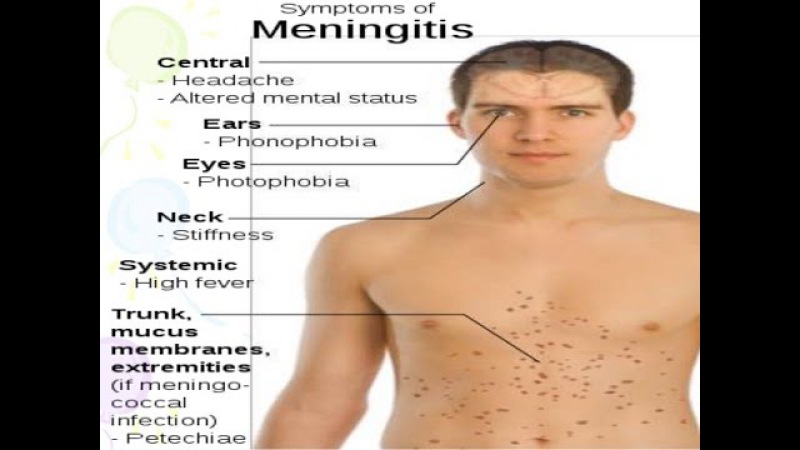 Meningitis syndrom