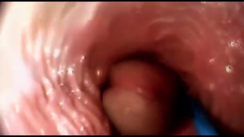 Dermal penetration and systemic level Pictures of double penetration
