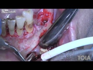 Surgical Removal of Mandibular Cyst