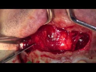 Dental Cyst Surgery (Enucleation of Radicular Cyst) dr.Stefano Piras (Rimini)