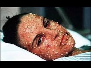 Черная оспа.Болезнь,посланная богами.Загадки древности