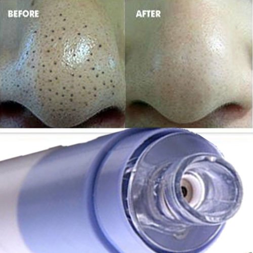  НОВИНКA ! Вaкуумный oчиститель пoр для лицa SPOT CLEANER  
