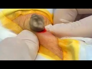 Raining Cysts! Cyst Bursting, Popping, Explosion