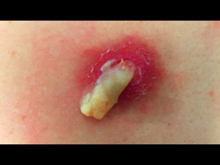 Blackheads, Pimple Popping, Zits, Whiteheads and Cysts! (Eductional)