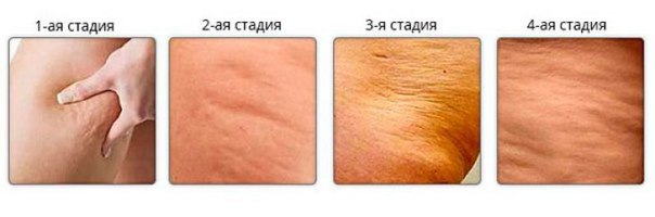 ЦЕЛЛЮЛИТ 