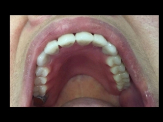 Dr- Azamat -Tekuyev - Smile-Designer - protezi - zubnie -Зубные Протезы