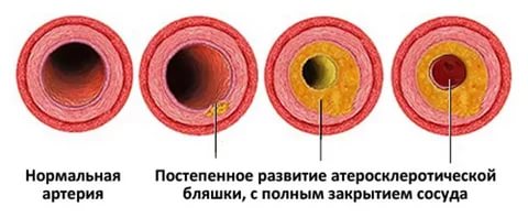 Сибирские ученые приступили к испытанию нового препарата для лечения атеросклероза