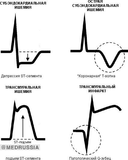 Шпаргалка по ЭКГ