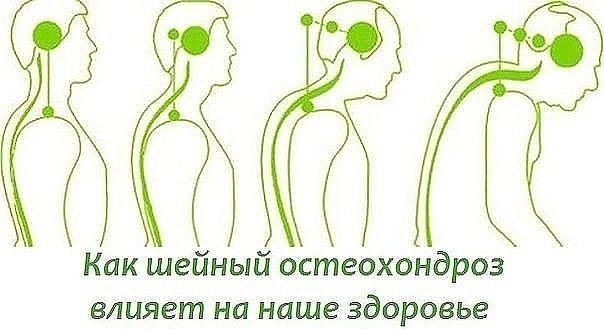 БОЛИТ ШЕЯ КАК ШЕЙНЫЙ ОСТЕОХОНДРОЗ ВЛИЯЕТ НА НАШЕ СОСТОЯНИЕ. 